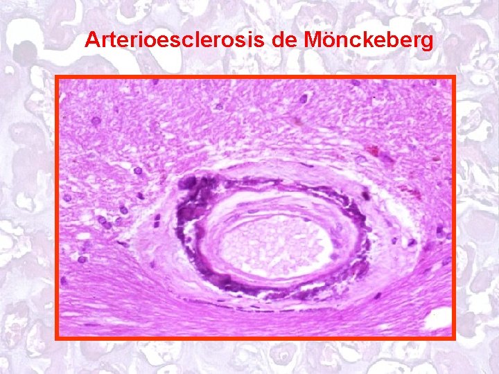 Arterioesclerosis de Mönckeberg 