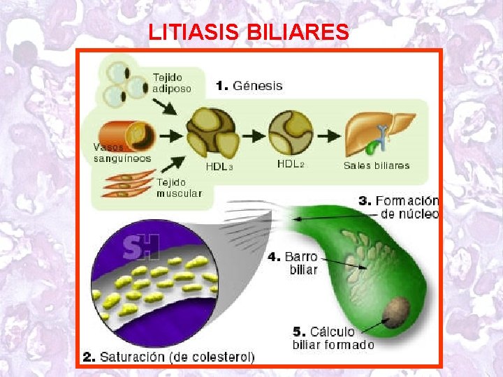 LITIASIS BILIARES 