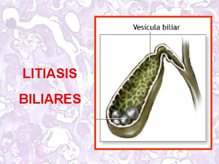 LITIASIS BILIARES 