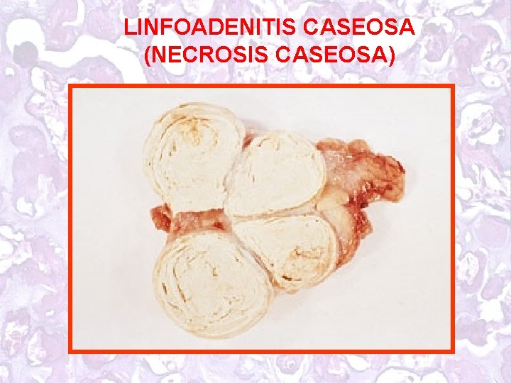 LINFOADENITIS CASEOSA (NECROSIS CASEOSA) 