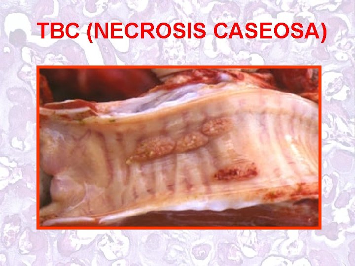 TBC (NECROSIS CASEOSA) 