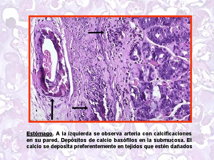 Estómago A la izquierda se observa arteria con calcificaciones en su pared. Depósitos de