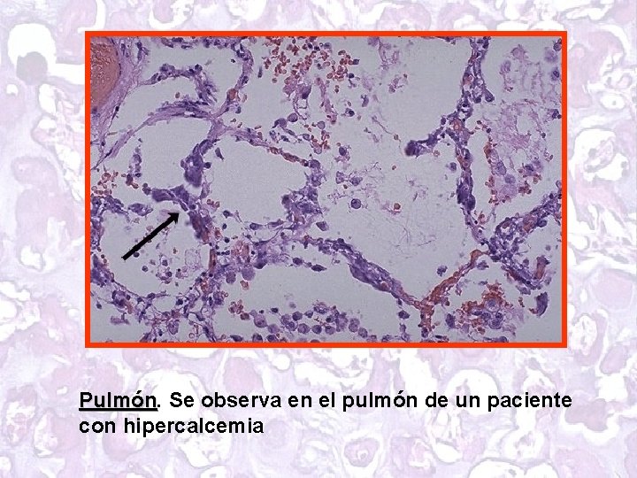 Pulmón Se observa en el pulmón de un paciente con hipercalcemia 