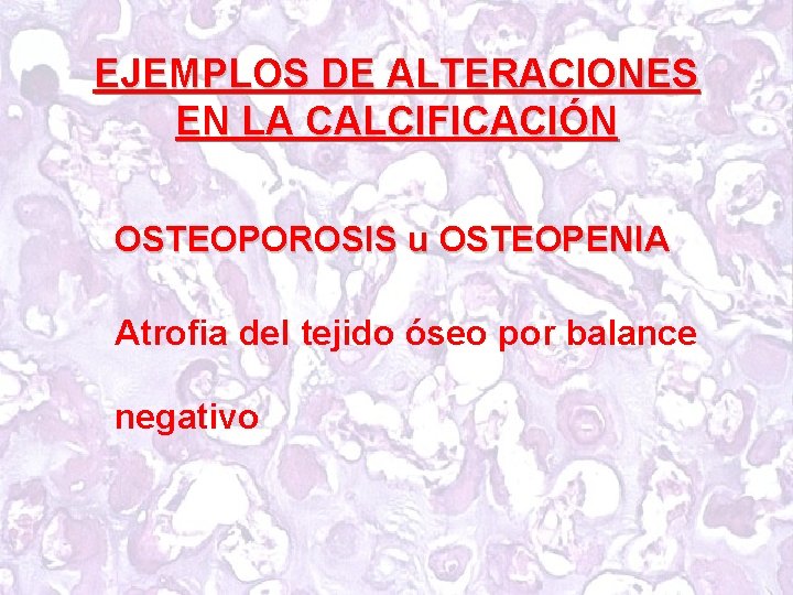 EJEMPLOS DE ALTERACIONES EN LA CALCIFICACIÓN OSTEOPOROSIS u OSTEOPENIA Atrofia del tejido óseo por