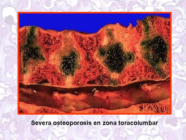 Severa osteoporosis en zona toracolumbar 