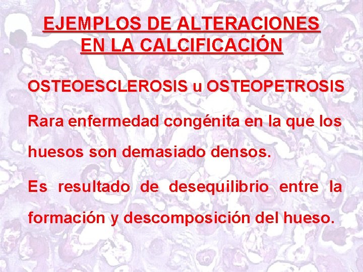 EJEMPLOS DE ALTERACIONES EN LA CALCIFICACIÓN OSTEOESCLEROSIS u OSTEOPETROSIS Rara enfermedad congénita en la