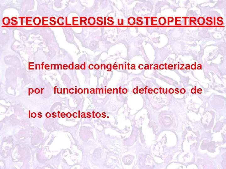 OSTEOESCLEROSIS u OSTEOPETROSIS Enfermedad congénita caracterizada por funcionamiento defectuoso de los osteoclastos. 