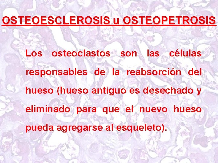 OSTEOESCLEROSIS u OSTEOPETROSIS Los osteoclastos son las células responsables de la reabsorción del hueso