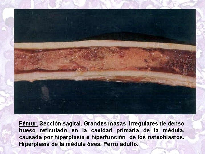 Fémur. Sección sagital. Grandes masas irregulares de denso hueso reticulado en la cavidad primaria