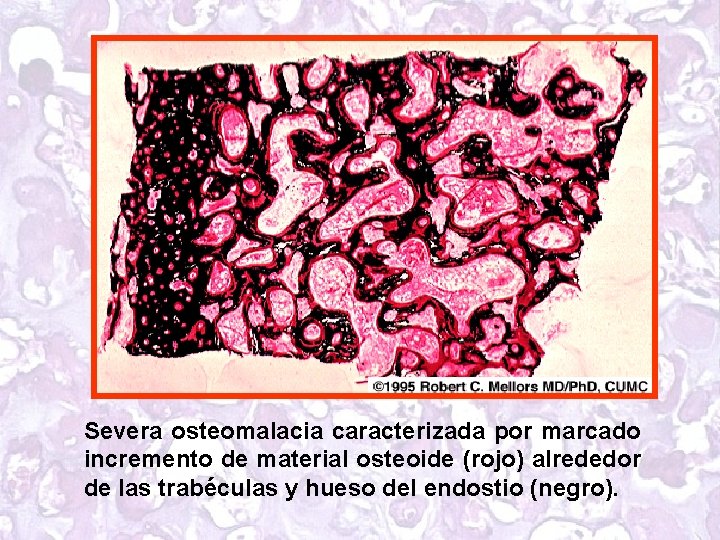 Severa osteomalacia caracterizada por marcado incremento de material osteoide (rojo) alrededor de las trabéculas