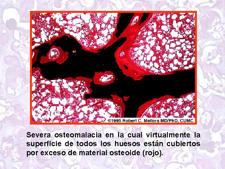 Severa osteomalacia en la cual virtualmente la superficie de todos los huesos están cubiertos