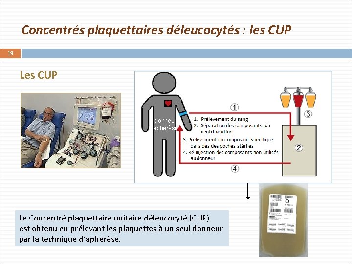 Concentrés plaquettaires déleucocytés : les CUP 19 Les CUP donneur aphérèse Sang complet Le