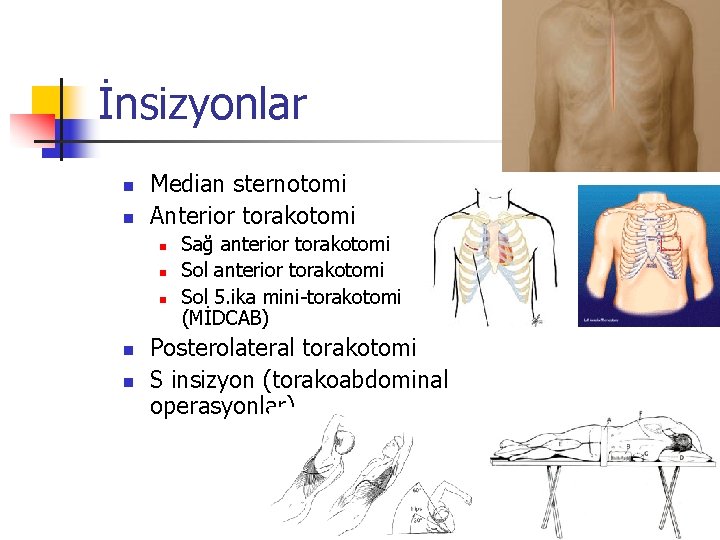 İnsizyonlar n n Median sternotomi Anterior torakotomi n n n Sağ anterior torakotomi Sol