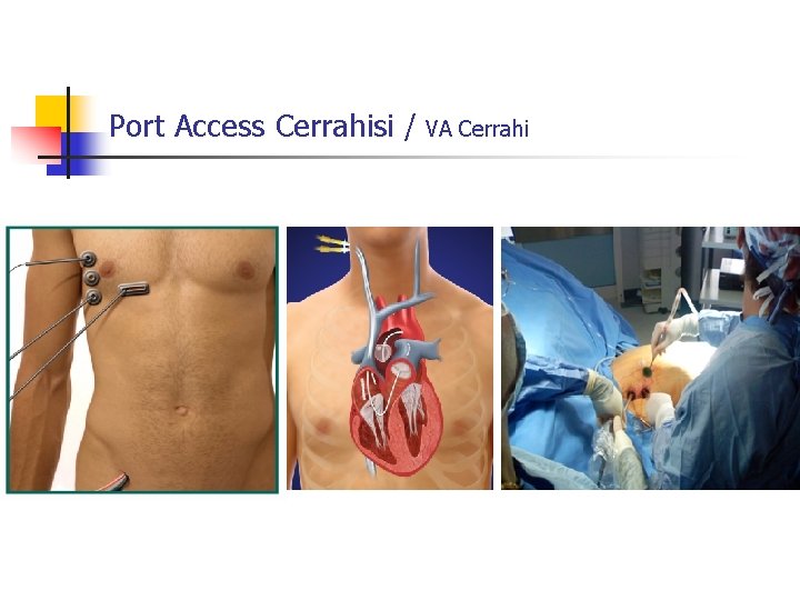 Port Access Cerrahisi / VA Cerrahi 