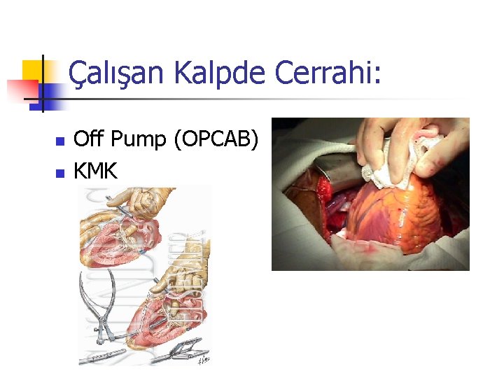 Çalışan Kalpde Cerrahi: n n Off Pump (OPCAB) KMK 