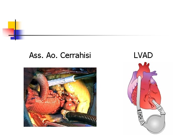 Ass. Ao. Cerrahisi LVAD 