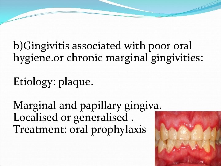 b)Gingivitis associated with poor oral hygiene. or chronic marginal gingivities: Etiology: plaque. Marginal and