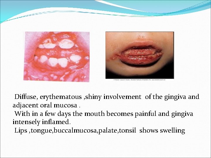 Diffuse, erythematous , shiny involvement of the gingiva and adjacent oral mucosa. With in