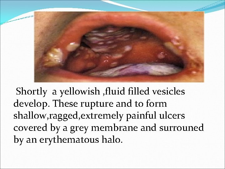 Shortly a yellowish , fluid filled vesicles develop. These rupture and to form shallow,