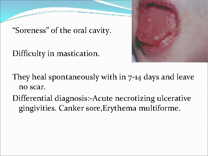 “Soreness” of the oral cavity. Difficulty in mastication. They heal spontaneously with in 7