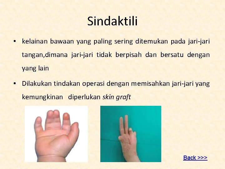 Sindaktili • kelainan bawaan yang paling sering ditemukan pada jari-jari tangan, dimana jari-jari tidak