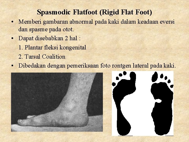 Spasmodic Flatfoot (Rigid Flat Foot) • Memberi gambaran abnormal pada kaki dalam keadaan eversi