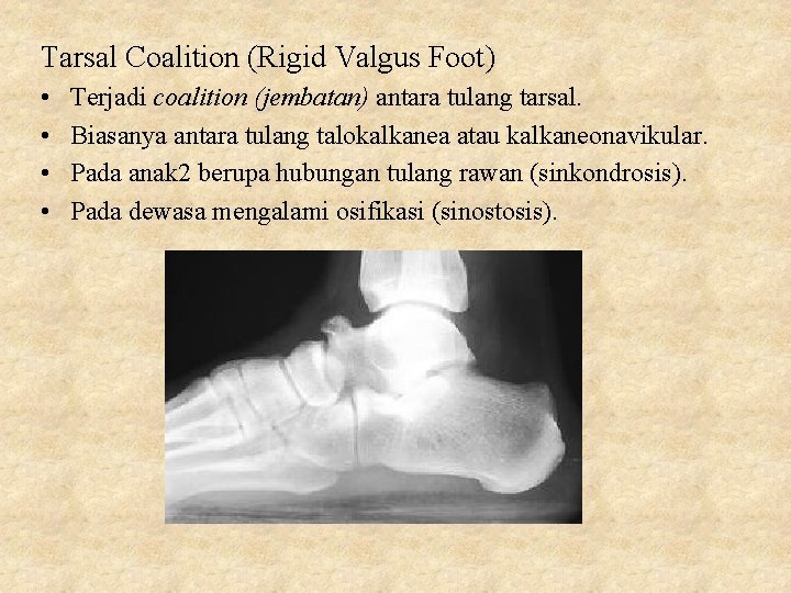 Tarsal Coalition (Rigid Valgus Foot) • • Terjadi coalition (jembatan) antara tulang tarsal. Biasanya