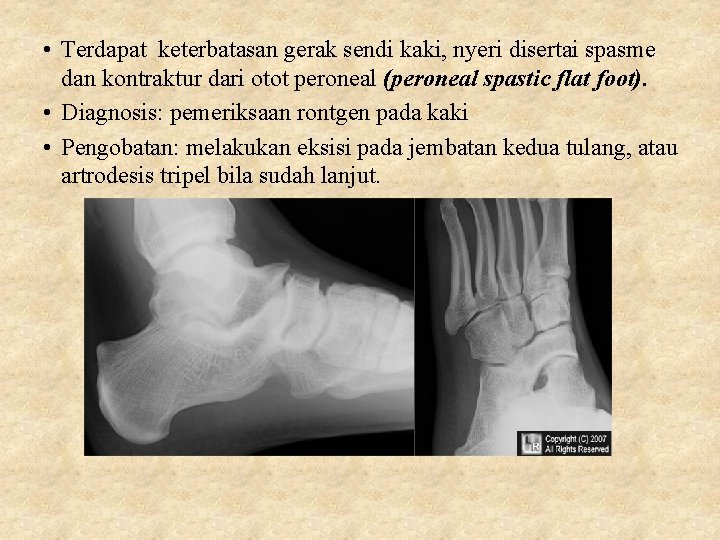  • Terdapat keterbatasan gerak sendi kaki, nyeri disertai spasme dan kontraktur dari otot
