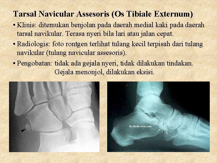 Tarsal Navicular Assesoris (Os Tibiale Externum) • Klinis: ditemukan benjolan pada daerah medial kaki