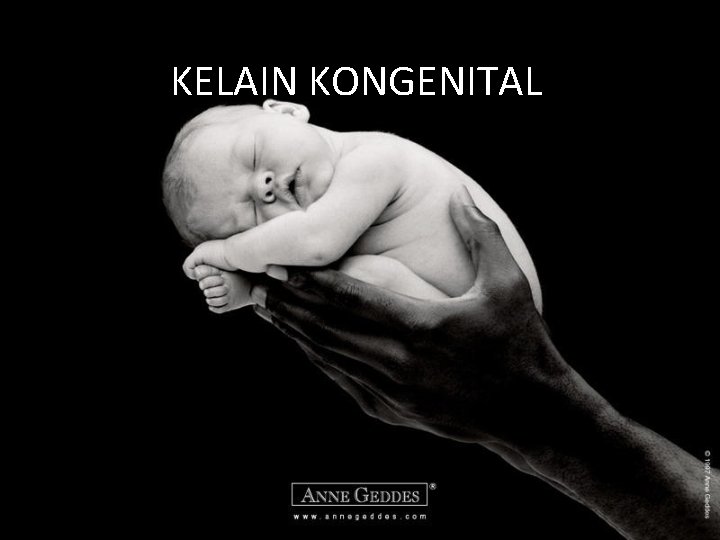 KELAIN KONGENITAL 