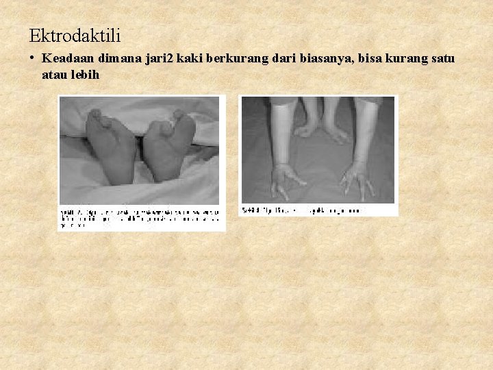 Ektrodaktili • Keadaan dimana jari 2 kaki berkurang dari biasanya, bisa kurang satu atau