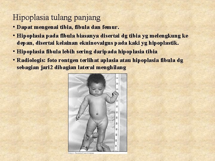 Hipoplasia tulang panjang • Dapat mengenai tibia, fibula dan femur. • Hipoplasia pada fibula