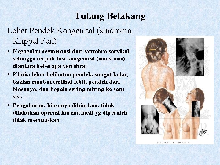 Tulang Belakang Leher Pendek Kongenital (sindroma Klippel Feil) • Kegagalan segmentasi dari vertebra servikal,