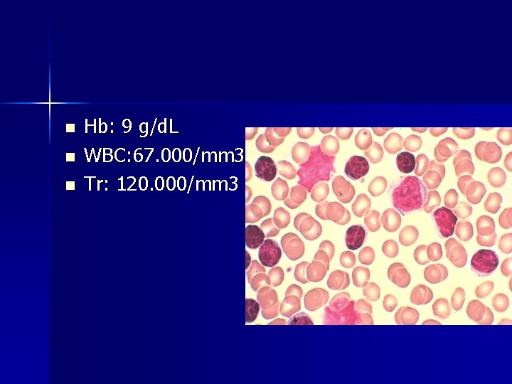 n n n Hb: 9 g/d. L WBC: 67. 000/mm 3 Tr: 120. 000/mm n n n Hb: 9 g/d. L WBC: 67. 000/mm 3 Tr: 120. 000/mm