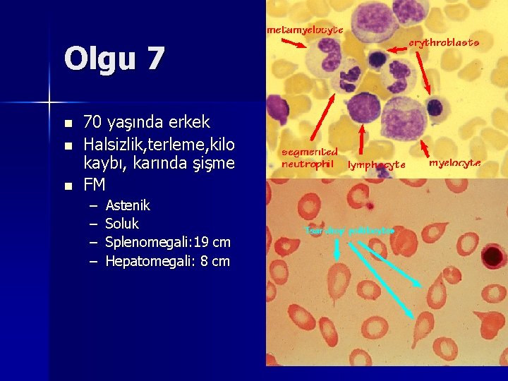Olgu 7 n n n 70 yaşında erkek Halsizlik, terleme, kilo kaybı, karında şişme Olgu 7 n n n 70 yaşında erkek Halsizlik, terleme, kilo kaybı, karında şişme