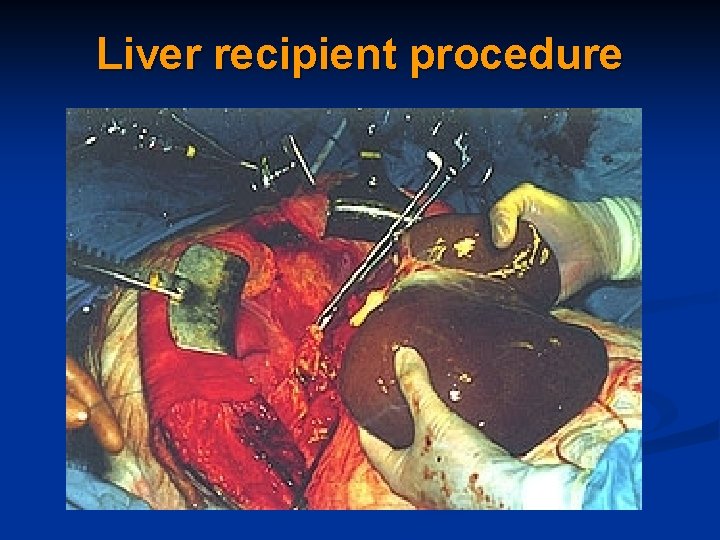 Liver recipient procedure 