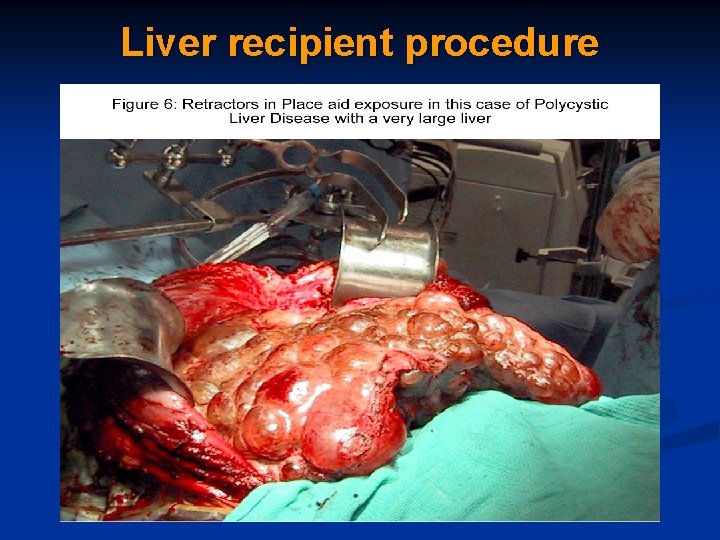 Liver recipient procedure 