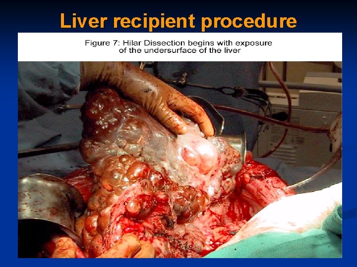 Liver recipient procedure 