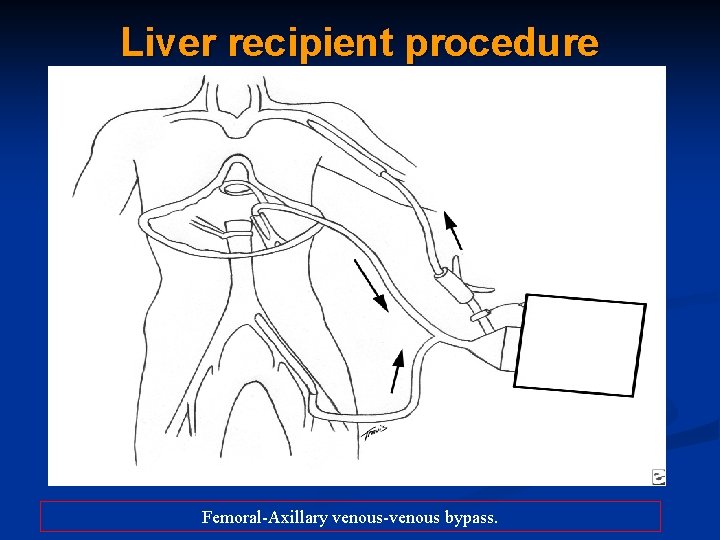 Liver recipient procedure Femoral-Axillary venous-venous bypass. 