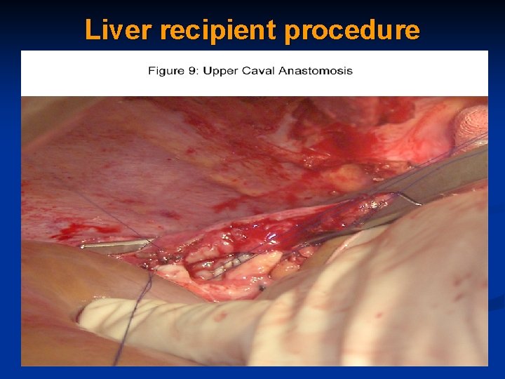 Liver recipient procedure 