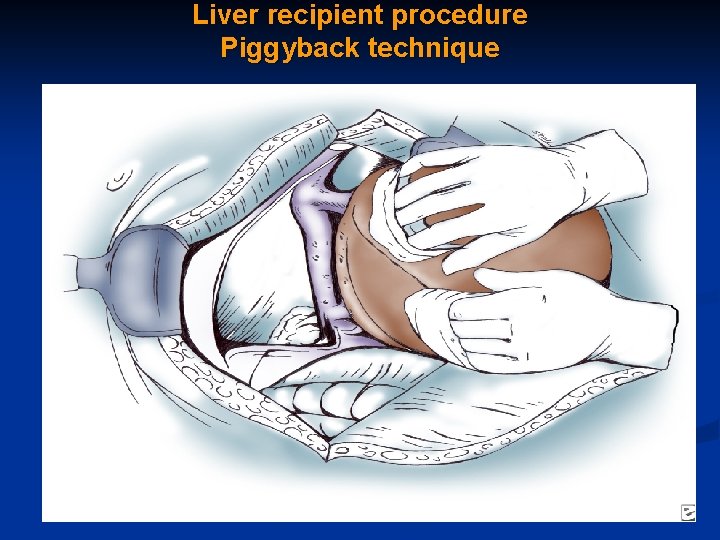 Liver recipient procedure Piggyback technique 