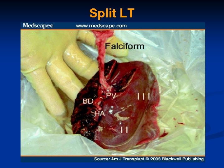Split LT 
