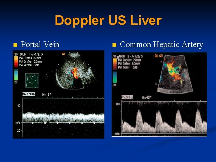 Doppler US Liver n Portal Vein n Common Hepatic Artery 