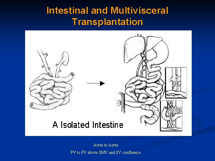 Intestinal and Multivisceral Transplantation Aorta to Aorta PV to PV above SMV and SV