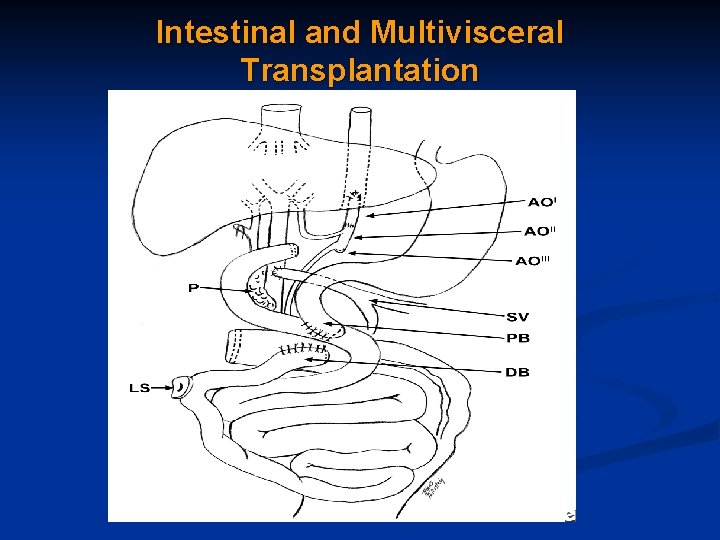 Intestinal and Multivisceral Transplantation 
