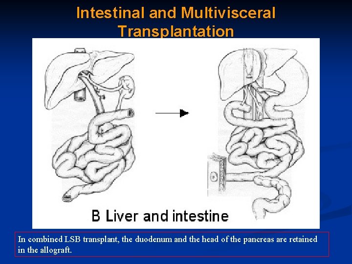 Intestinal and Multivisceral Transplantation In combined LSB transplant, the duodenum and the head of