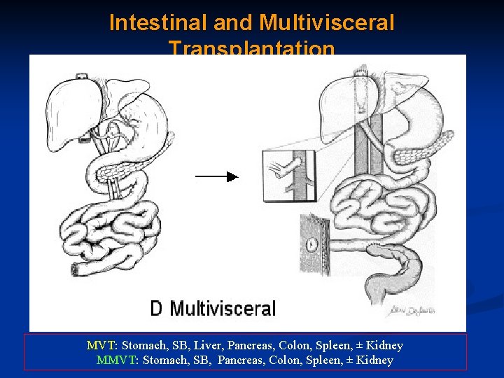 Intestinal and Multivisceral Transplantation MVT: Stomach, SB, Liver, Pancreas, Colon, Spleen, ± Kidney MMVT:
