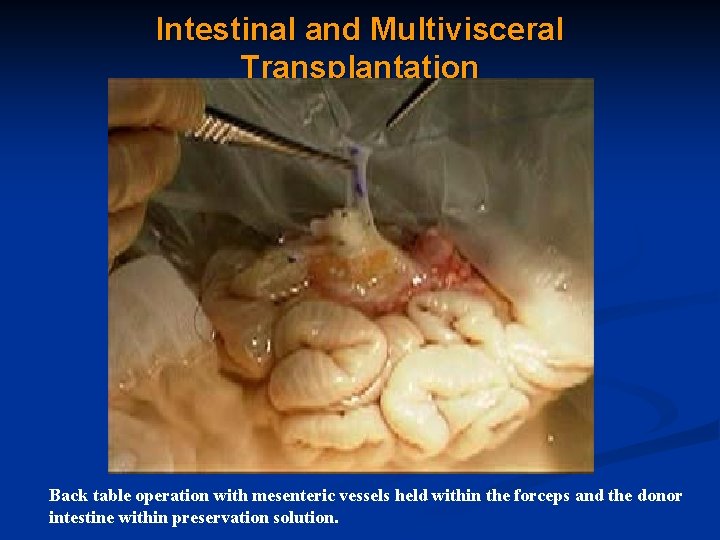Intestinal and Multivisceral Transplantation Back table operation with mesenteric vessels held within the forceps