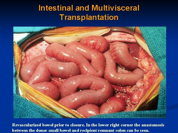 Intestinal and Multivisceral Transplantation Revascularized bowel prior to closure. In the lower right corner