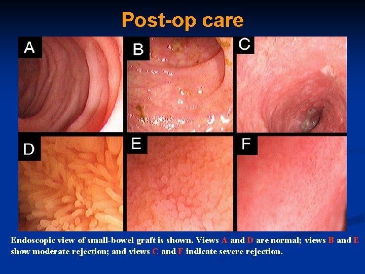 Post-op care Endoscopic view of small-bowel graft is shown. Views A and D are